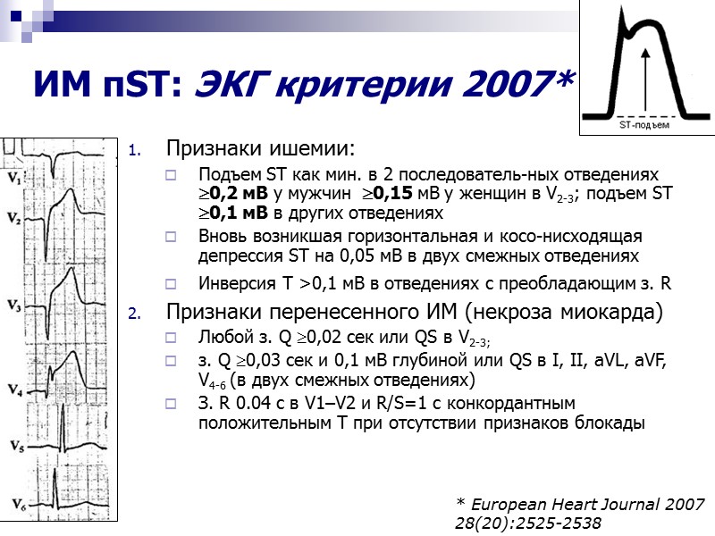 ИМ пST: ЭКГ критерии 2007* Признаки ишемии: Подъем ST как мин. в 2 последователь-ных